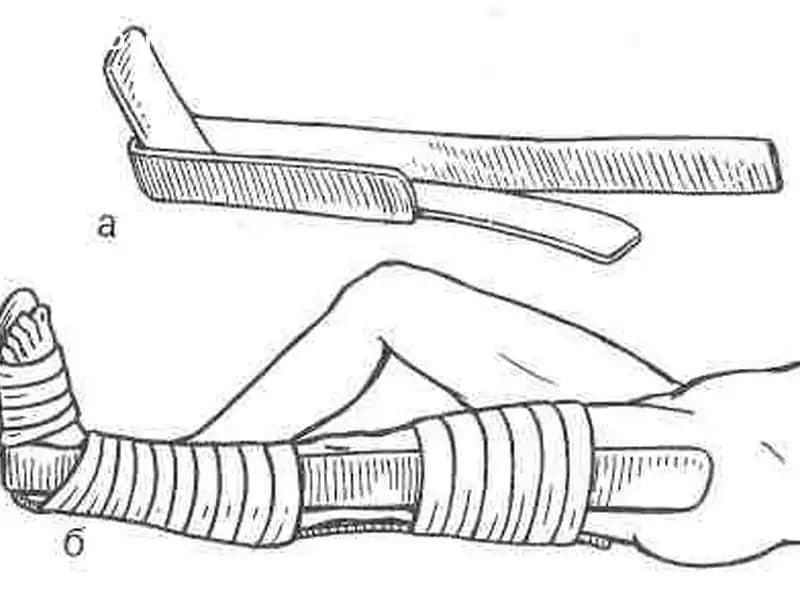 Как необходимо накладывать шины при переломе костей голени?