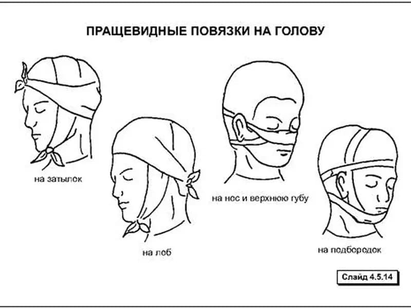 В каком из перечисленных случаев накладывается пращевидная повязка?