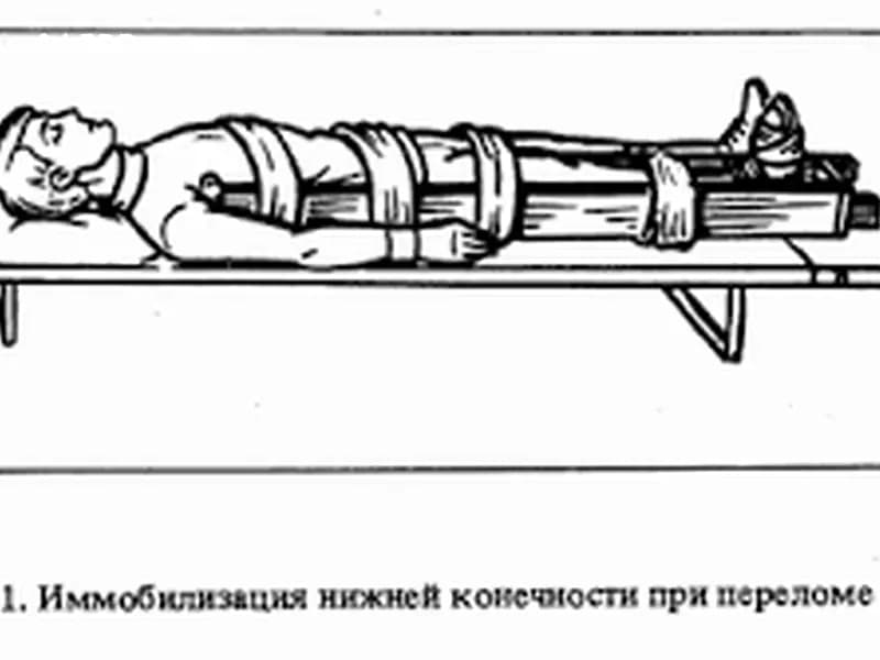 Как необходимо накладывать шины при переломе нижней трети бедра?
