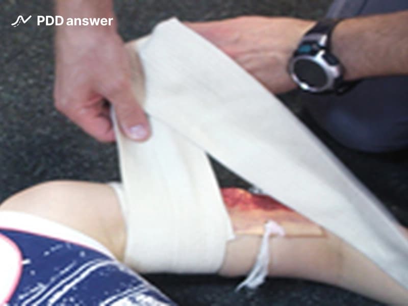 Как правильно оказать первую помощь при термическом ожоге?