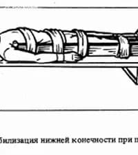 Как правильно зафиксировать шинами место перелома?
