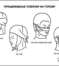 В каком из перечисленных случаев накладывается пращевидная повязка?